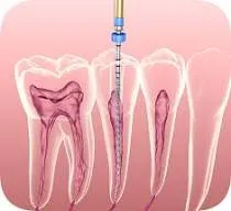 Prevalence of Accessory Canals and Morphological Variations, Using CBCT, in Maxillary First Molars of Patients Attending Private University Hospitals in Riyadh City  "A Retrospective Study"